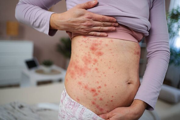 Woman suffering from a painful allergic skin rash