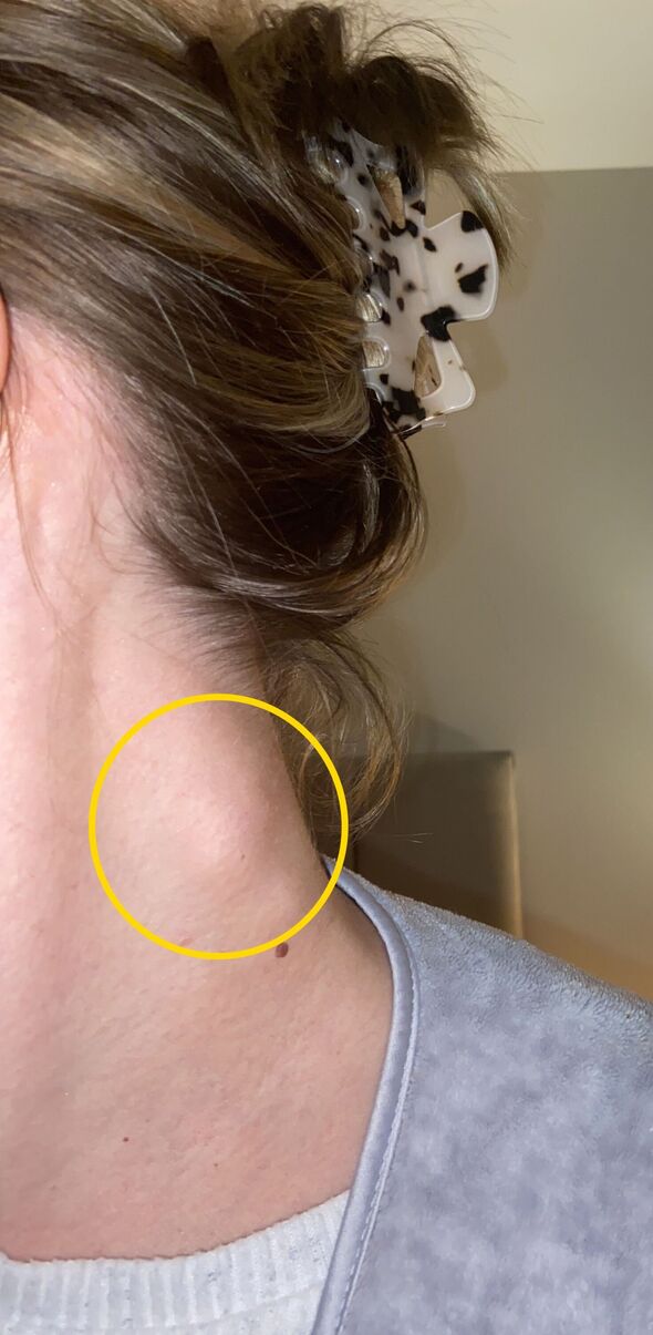Swollen lymph node on the neck