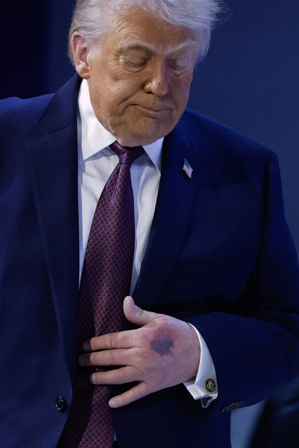 A bruise can be seen on the back of U.S. President Donald Trump's left hand during a signing ceremony for the “Board of Peaceâ
