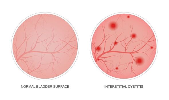 A normal bladder versus those with IC