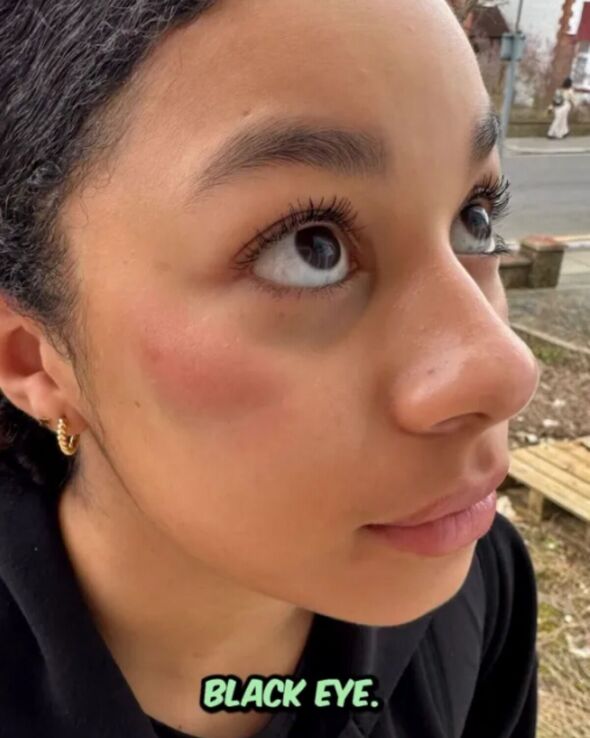 His daughter Sienna suffered a black eye in the violent incident