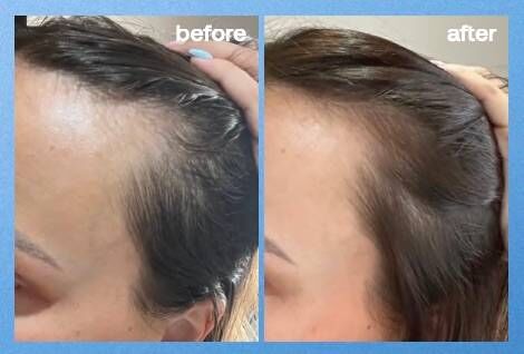 before and after using uklash hair growth serum