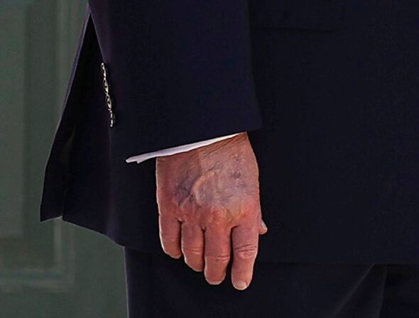 EXPRESS *PRIO* Trump's hand appears swollen and discolored after 4-day disappearance from public dut